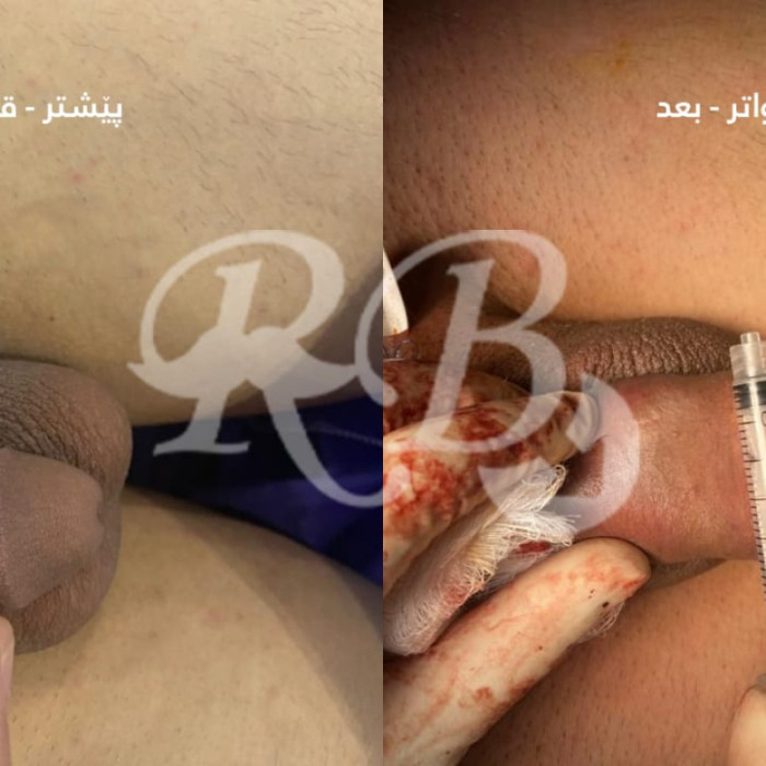 تكبير القضيب