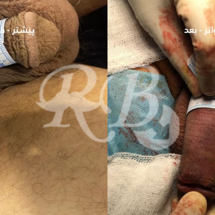 تكبير القضيب