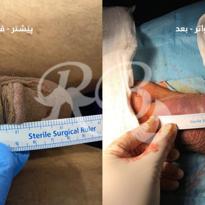 تكبير القضيب