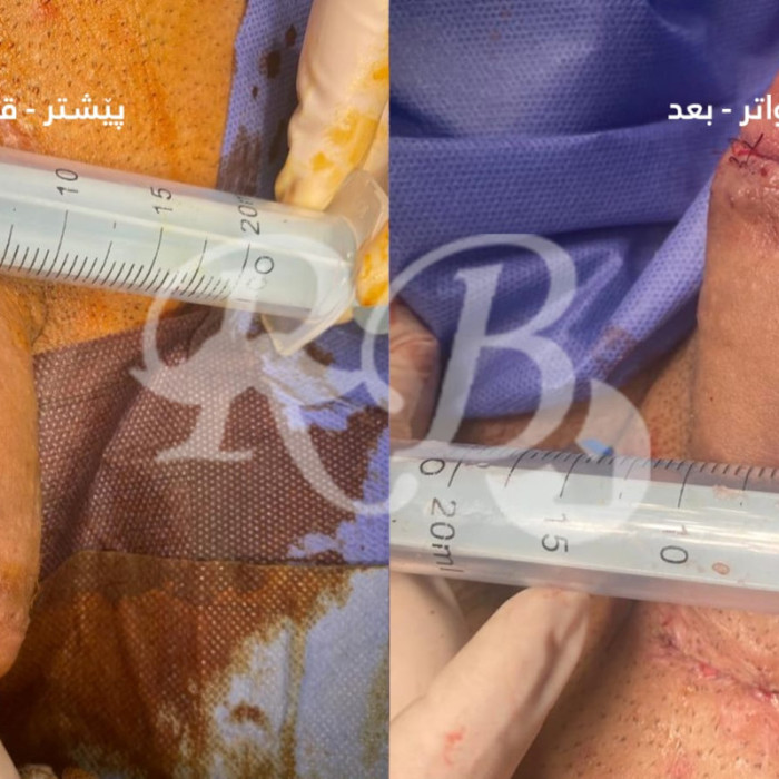 تكبير القضيب