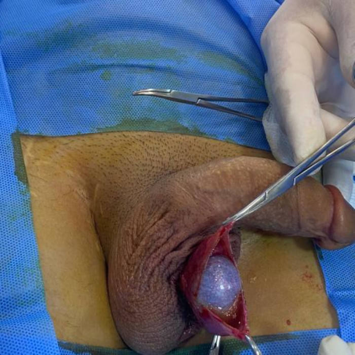 استكشاف الخصية