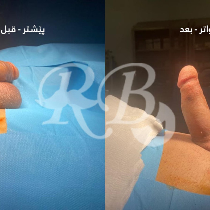 دعامات القضيب